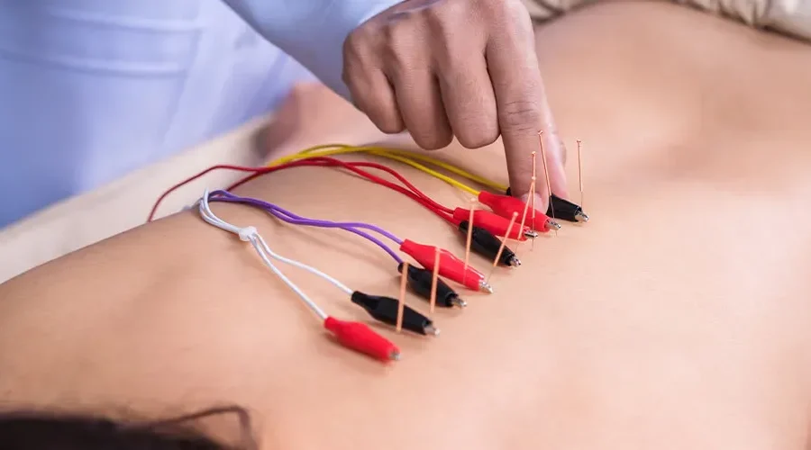Electroacupuncture